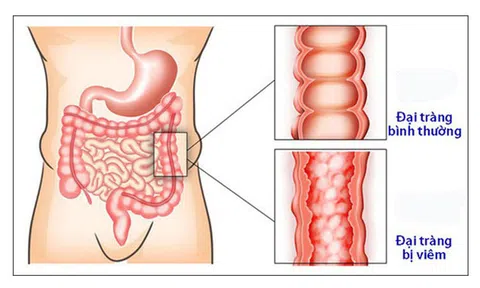 'Đại Tràng Hoàn' – Xua tan nỗi lo bệnh đại tràng